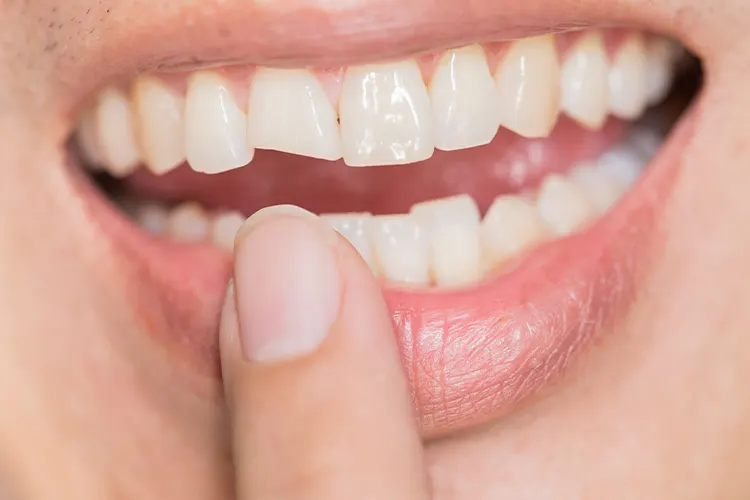 BROKEN OR CRACKED TOOTH