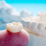 Can You Whiten Dental Crowns?