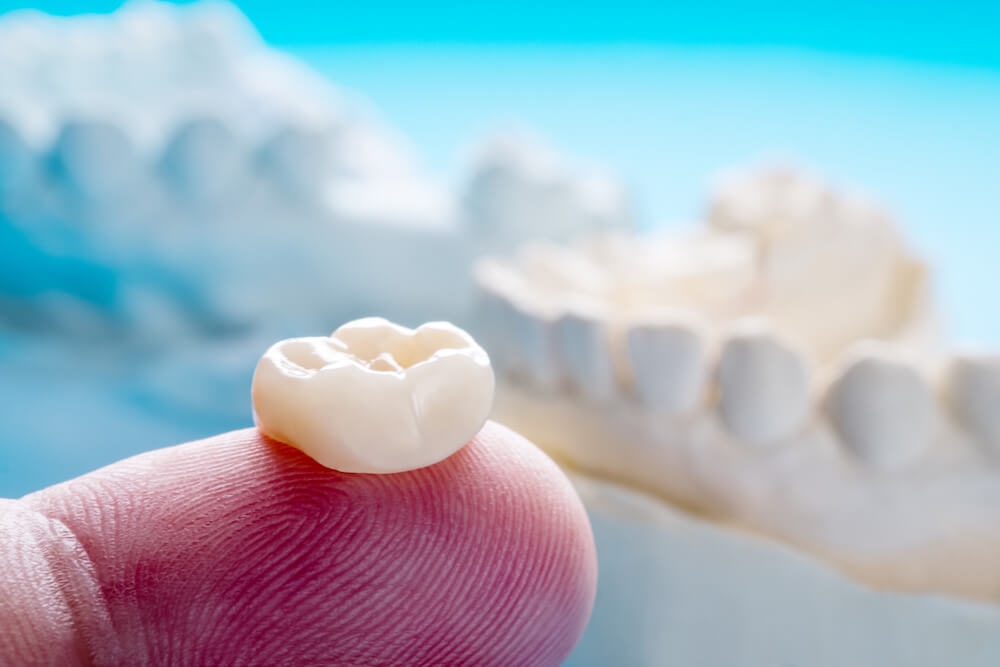 Can You Whiten Dental Crowns?