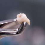 How Long After a Tooth Extraction Can I Eat?