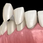 Porcelain vs. Composite Veneers: Which is the Right Choice for You?