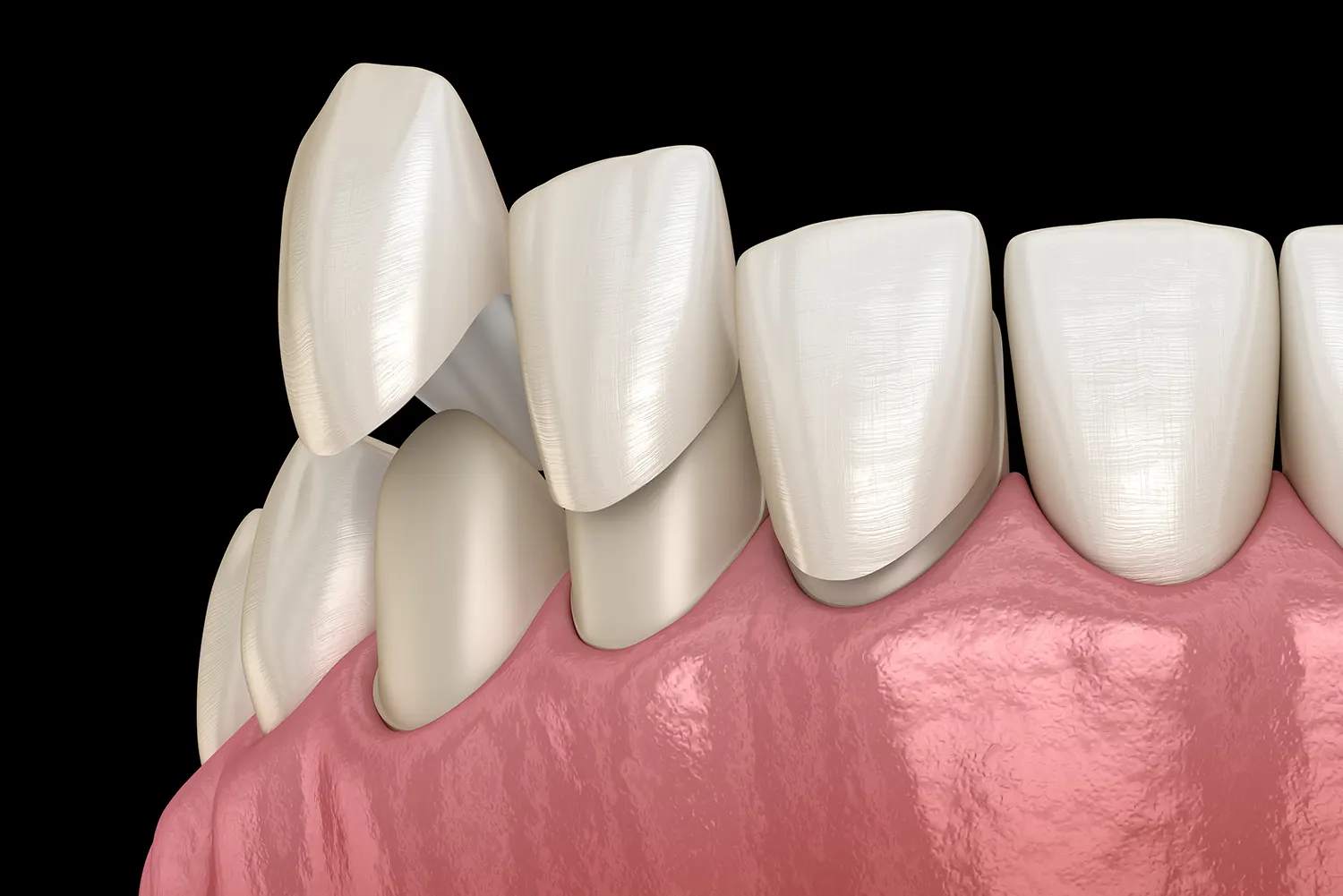 Porcelain vs. Composite Veneers: Which is the Right Choice for You?