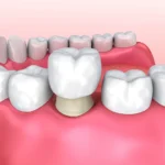 What to Expect After Getting a Dental Crown: Care and Maintenance Tips