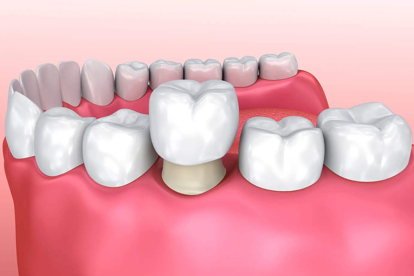 What to Expect After Getting a Dental Crown: Care and Maintenance Tips