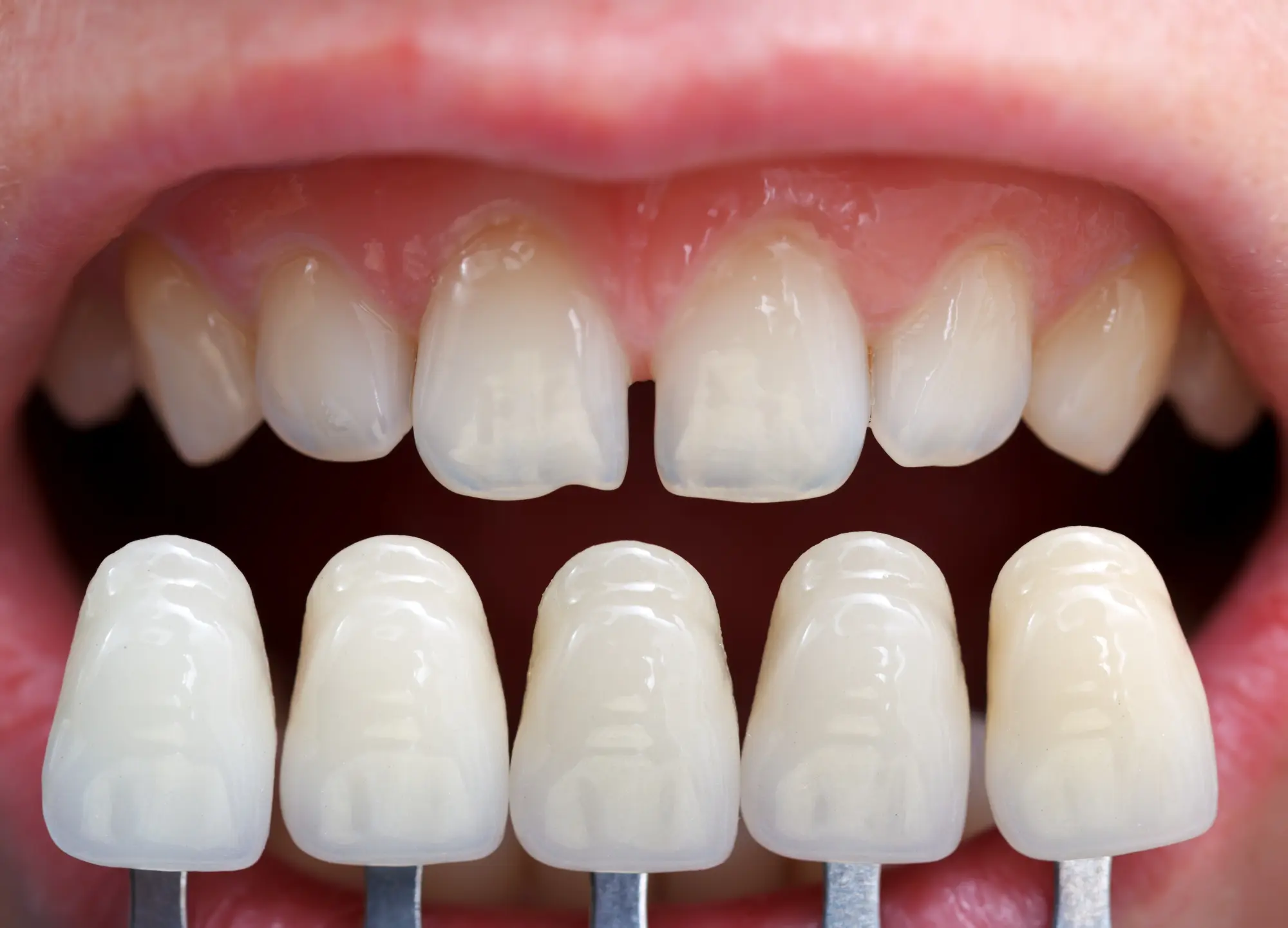Can Veneers Correct Gaps Between Teeth?